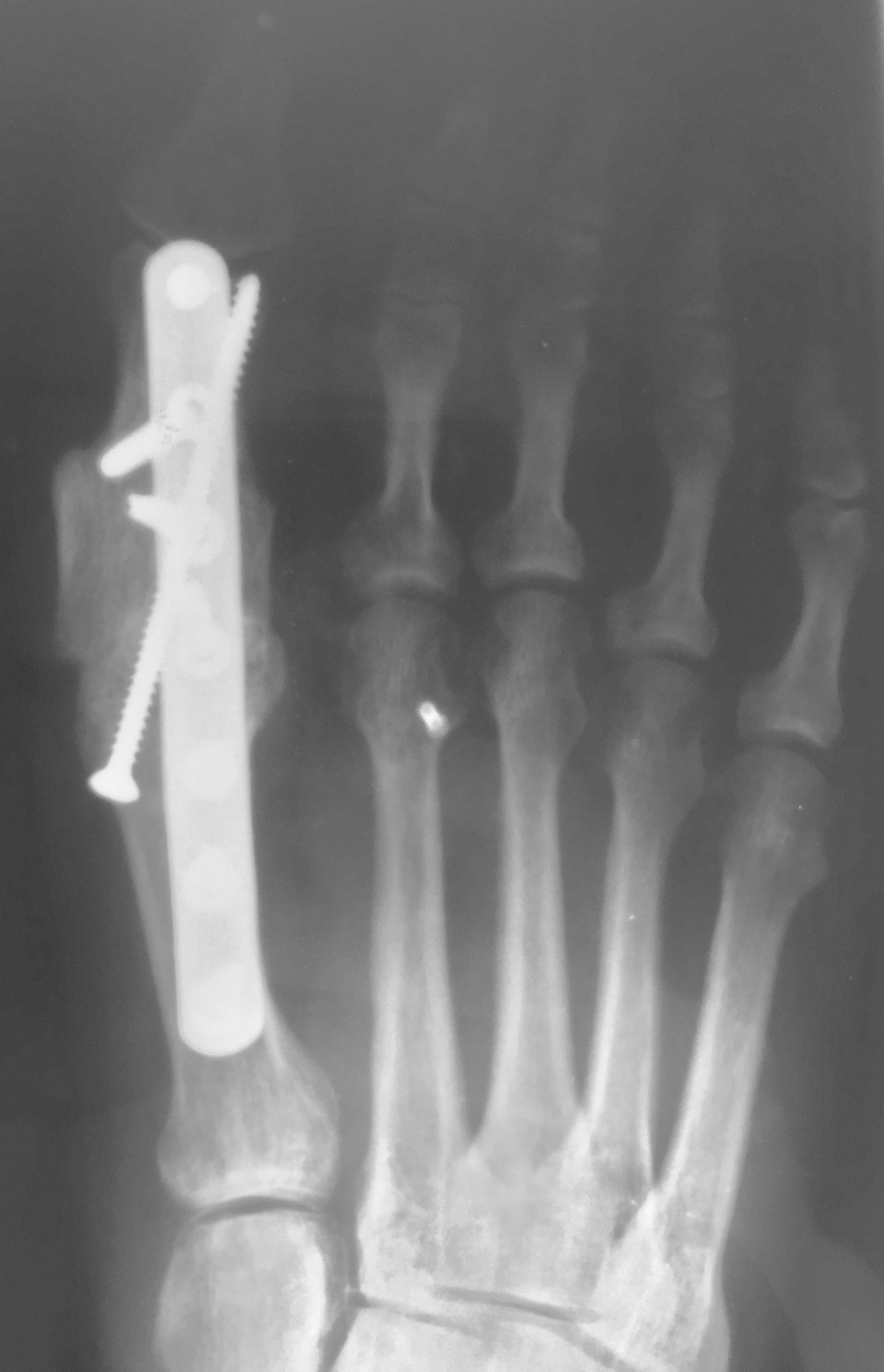 Current Concepts With Autogenous Bone Grafting